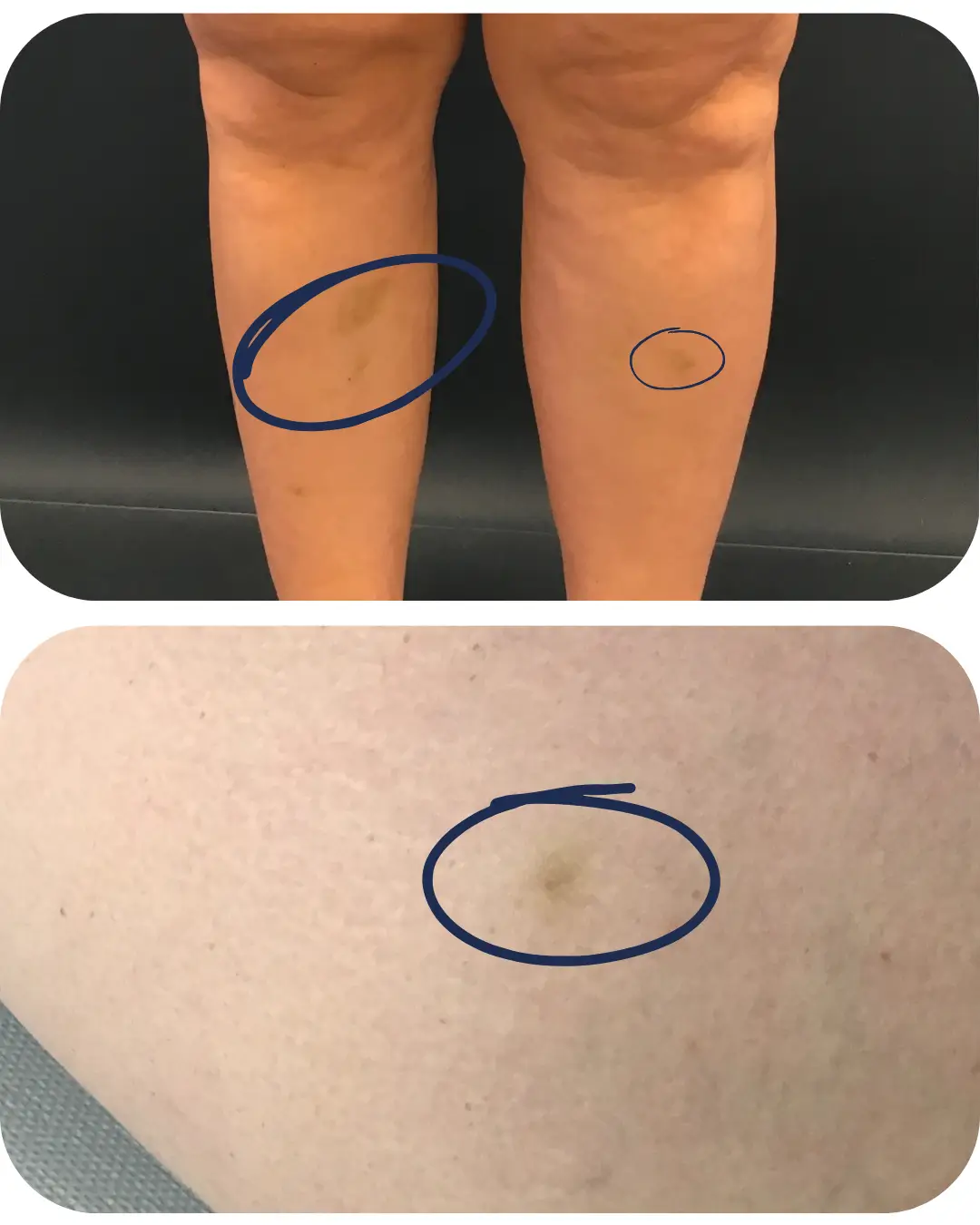 Blaue Flecken an den Beinen bei Lipödem