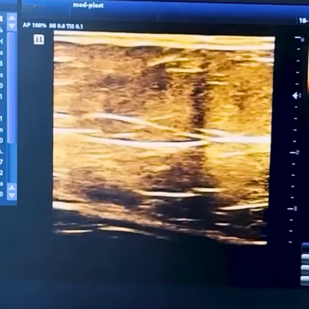 Lipödem Untersuchung per Ultraschall die Faszien vor der OP werden untersucht.