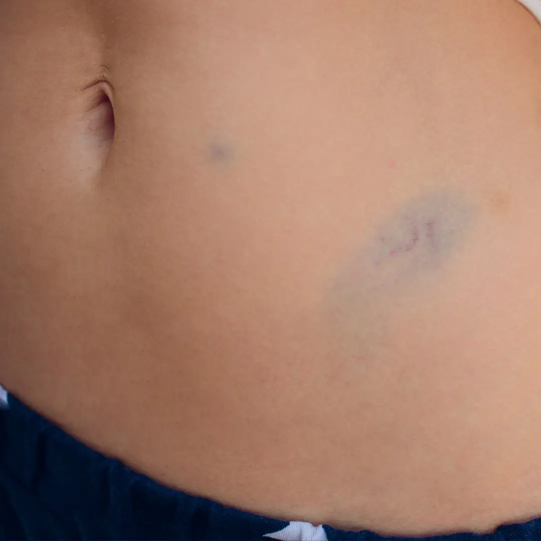 Blaue Flecken am Bauch