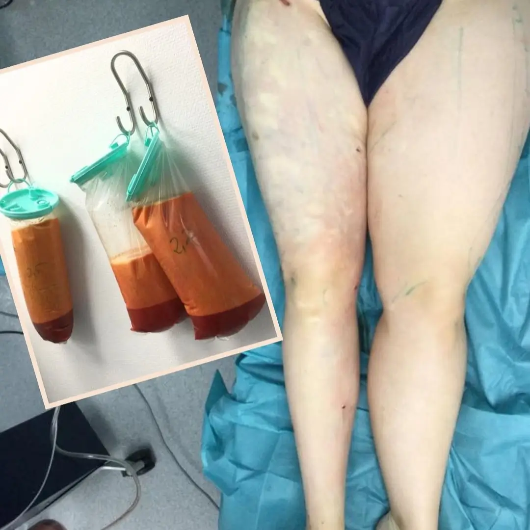 Lipödem OP – gezielte Hilfe durch plastische Chirurgie