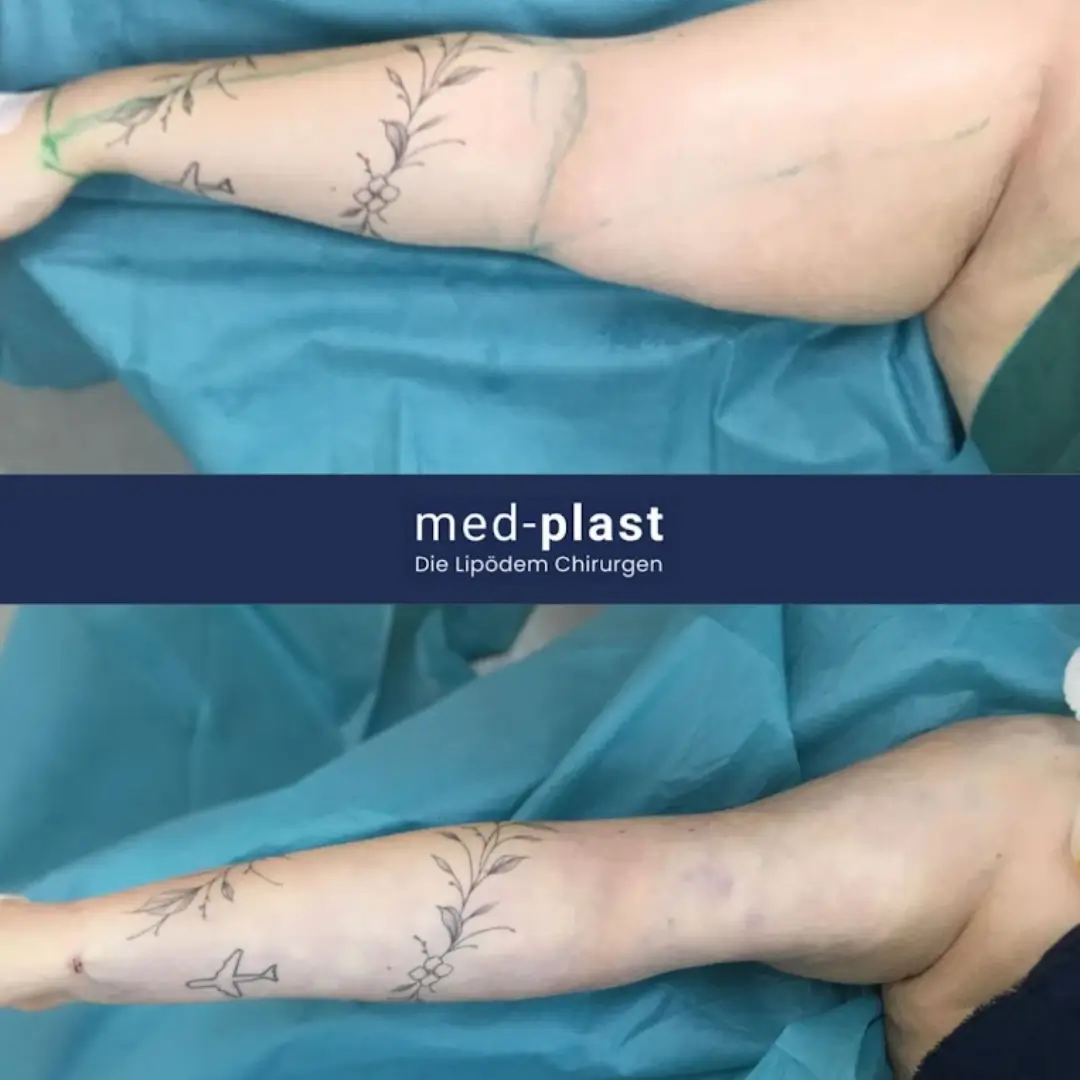 Vorher-Nachher Ergebnis einer Lipödem-OP an den Armen – deutliche Veränderung nach der Liposuktion bei med-plast