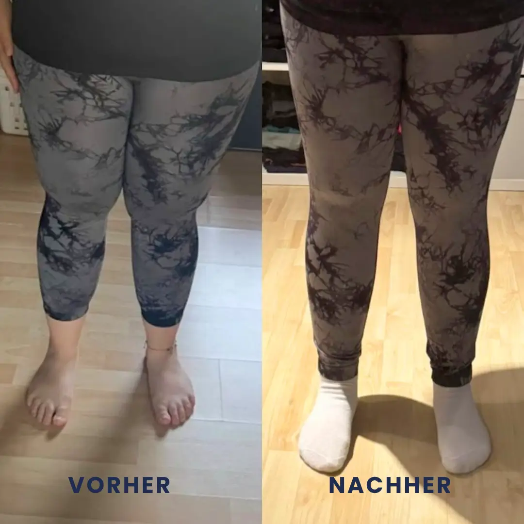 Vorher-Nachher Vergleich einer Lipödem-OP an den Beinen – deutlich schlankere Kontur nach der Liposuktion