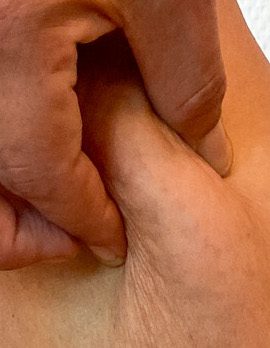 Lipödem Pinch Test