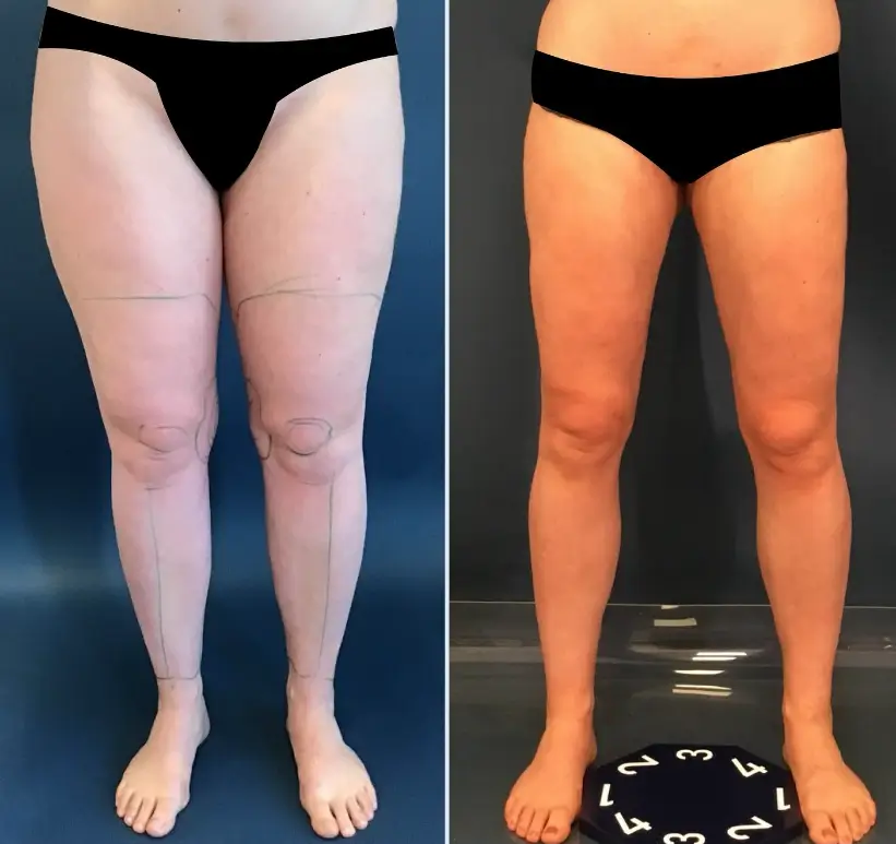 Vorher-Nachher-Vergleich der Beine einer med-plast Patientin mit Lipödem – deutlich schmalere Konturen nach WAL-Liposuktion