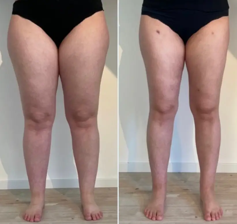 Vorher-Nachher-Vergleich der Beine einer med-plast Patientin mit Lipödem Stadium 2 – nach WAL-Liposuktion sichtbar weniger Volumen und harmonischere Proportionen