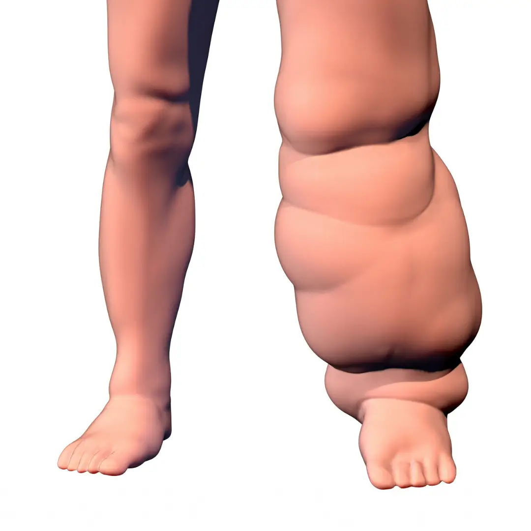Lymphödem oder Lipödem, was habe ich?