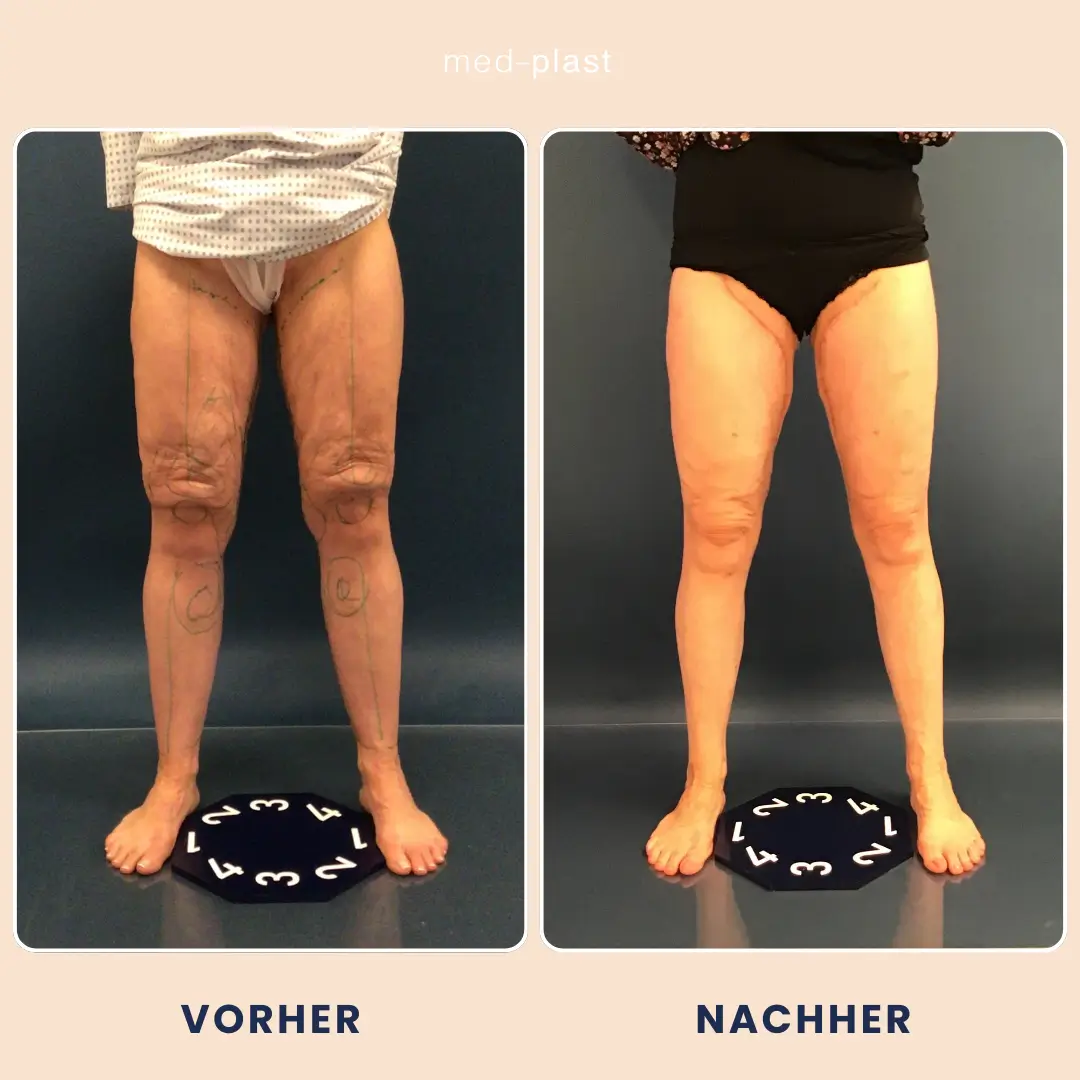 Vorher nachher Lipödem OP mit Hautstraffung