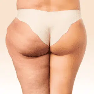 Zur Lipödem Diagnose und Beratung