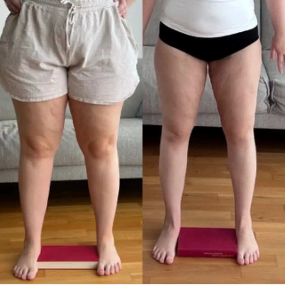 Vorher-Nachher-Vergleich der Beine einer Lipödem-Patientin – links vor der Liposuktion, rechts nach der Lipödem-OP bei med-plast