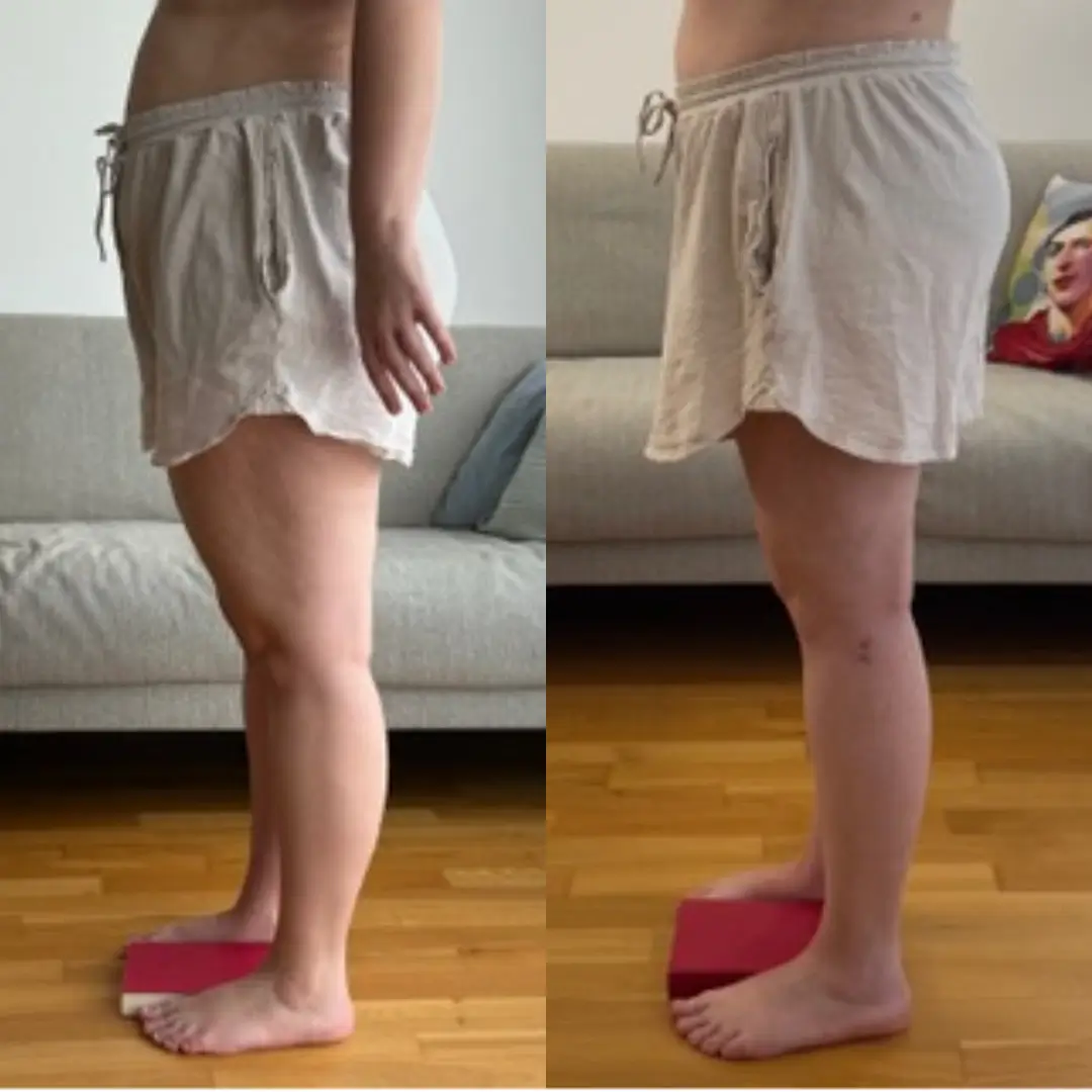 Seitlicher Vorher-Nachher-Vergleich einer Lipödem-Patientin – links vor der Fettabsaugung, rechts nach der Liposuktion an den Beinen
